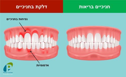 דלקת חניכיים - חניכיים בריאות מול חניכיים מודלקות - פריוסנטר