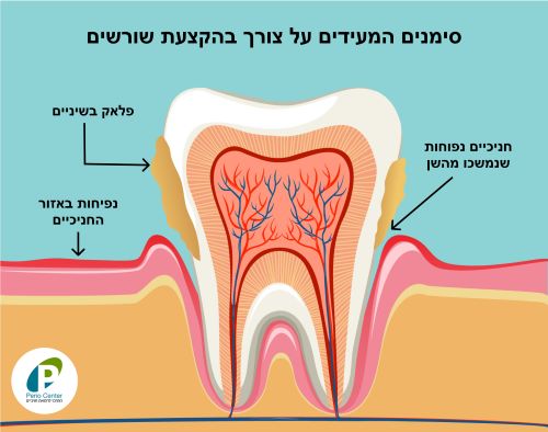 הקצעת שורשים - מהם הסימנים המעידים על הצורך בכך - פריוסנטר