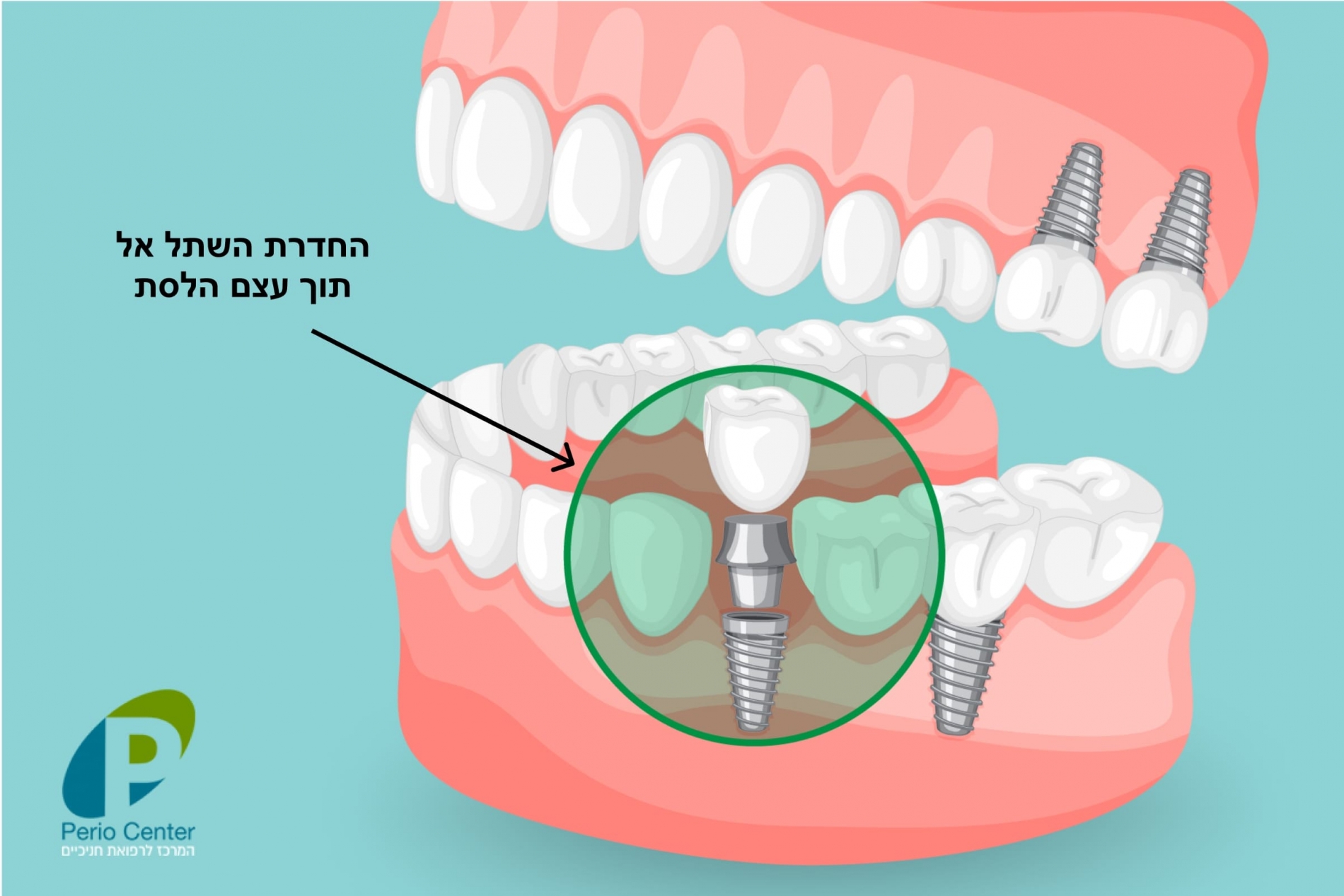 השתלת שיניים - תהליך החדרת השתל על ידי מומחים - פריוסנטר המרכז לרפואת חניכיים