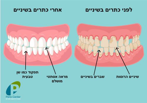 כתרים לשיניים - לפני ואחרי כתר בשן - פריוסנטר