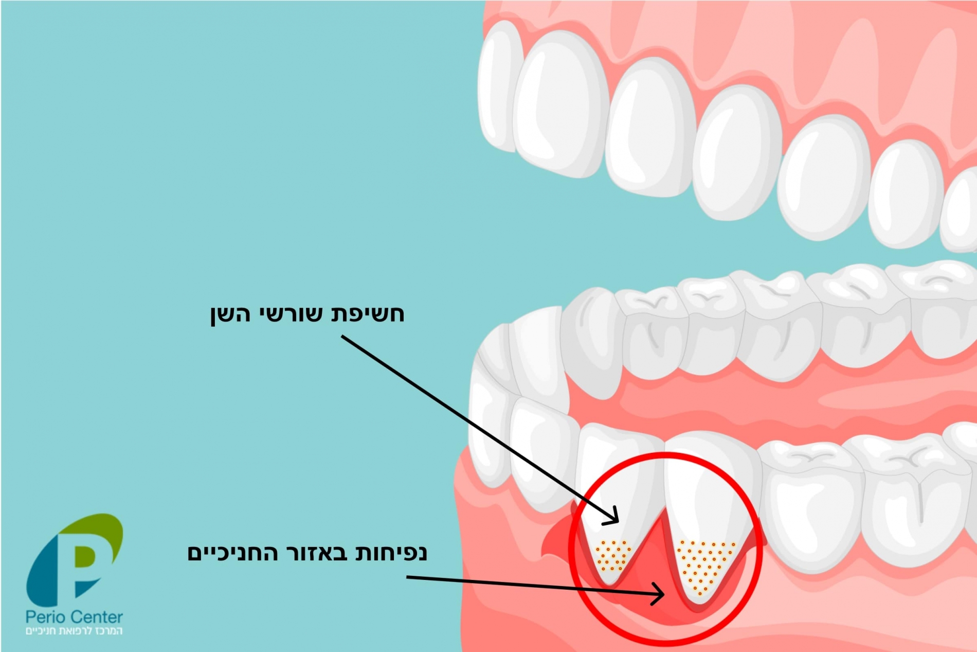 נסיגת חניכיים - סימנים וטיפול - פריוסנטר המרכז לרפואת חניכיים בחיפה